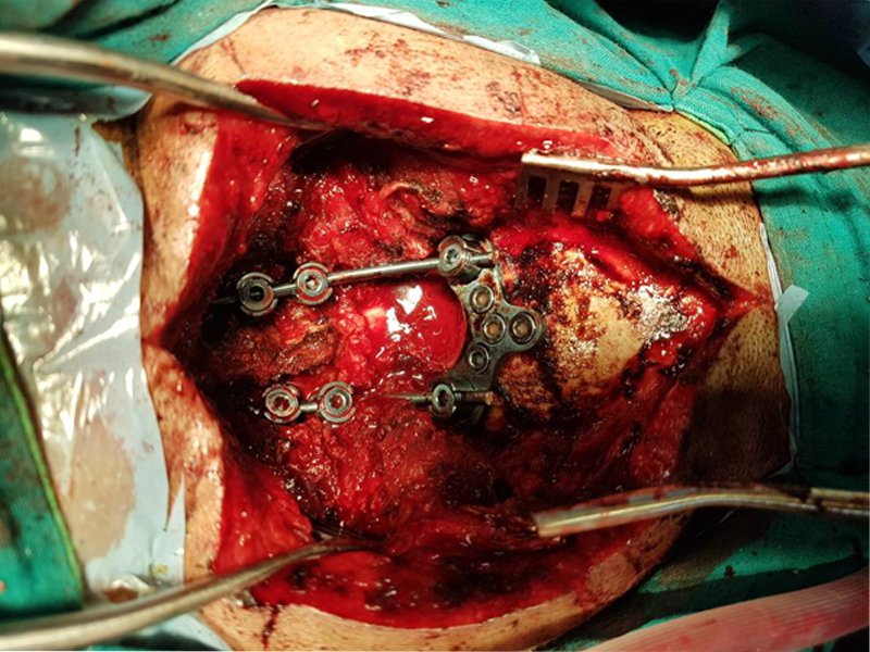 Best urology hospitals in Vijayawada,best urology doctors in Vijayawada,Best urology specialists in Vijayawada,best urology treatment hospitals in Vijayawada,Best paediatric urologists in Vijayawada,Best kidney Stone treatment in Vijayawada,Best prostate Gland treatment in Vijayawada,Best Laparoscopic Surgery in Vijayawada,Best Bladder Stone treatment in Vijayawada,Best Ureters Treatment in Vijayawada,Best Retrograde ureteral in Vijayawada,Best kidney transplantation in Vijayawada,Best prostatic hyperplasia Treatment in Vijayawada,Best Urologist in Vijayawada,Best Urinary Incontinence Treatment in Vijayawada,Best Gastroenterologists in Vijayawada,Best Gastroenterology hospitals in Vijayawada,Best Gastroenterology hospital in Vijayawada,Best gastroenterology treatment in Vijayawada,Best Gastroenteritis Treatment in Vijayawada,Best Hepatitis B Treatment in Vijayawada,Best Hernia Treatment in Vijayawada,Best Gallstones Treatment in Vijayawada,best neurosurgeon in Vijayawada,Best Brain tumor hospitals in Vijayawada,Best Stroke treatment in Vijayawada,Best Paralysis Treatment in Vijayawada,Best Rehabilitation Center in Vijayawada,Best Paediatric neurosurgery in Vijayawada,Best Neurovascular surgery in Vijayawada,Best Spine surgery in Vijayawada,Best Arthritis treatment in Vijayawada,Best Tumor removal in Vijayawada,Best Brain tumor treatment in Vijayawada,Best Neuro Surgery hospital in Vijayawada,Best neurology hospitals in Vijayawada,Best neurology doctors in Vijayawada,Best Neurologists in Vijayawada,best neurologist doctor in Vijayawada,Best Fits treatment in Vijayawada,Best Stroke Center in Vijayawada,Best Paralysis treatment in Vijayawada,Best Coma treatment center in Vijayawada,Best Migraine Hospital in Vijayawada,Best Spinal Card Injury Treatment in Vijayawada,best laparoscopic surgeon in Vijayawada,Best gall bladder stone removal surgery cost in Vijayawada,best general surgeon in Vijayawada,best gallbladder laparoscopic surgeon in Vijayawada,Best Advanced Laparoscopic and General Surgery in Vijayawada,Best Laparoscopic General Surgery in Vijayawada,best surgeon in Vijayawada,Top Laparoscopic surgeon Vijayawada,Best laparoscopic surgery hospitals in Vijayawada,Best Appendix Treatment in Vijayawada,Best Laparoscopic surgery in Vijayawada,Best Gallbladder microscope surgeons in Vijayawada,Advanced laparoscopic and general surgery hospitals in Vijayawada,Best General Surgery Hospitals in Vijayawada,best General Medicine Doctors in Vijayawada,Best General Physician Doctors in Vijayawada,Best General physicians in Vijayawada,Best General Medicine for Hypertension,Best Diabetologist in Vijayawada,Best Diabetics Hospital in Vijayawada,Best fever Hospital in Vijayawada,Best infections treatment in Vijayawada,Best Hypertension treatment in Vijayawada,Best thyroid treatment in Vijayawada,Best Hospitals for Pulmonology in Vijayawada,Best Pulmonologists in Vijayawada,Top Pulmonologists Doctors in Vijayawada,Best Pulmonology hospitals in Vijayawada,Best Asthma treatment in Vijayawada,Best Lung cancer treatment in Vijayawada,Best breathe easy treatment in Vijayawada,Best Asthma Specialist in Vijayawada,Best gynaecology hospitals in Vijayawada,Best gynaecology specialists in Vijayawada,best gynaecology hospitals in Vijayawada,Best obstetrics and gynaecology hospitals in Vijayawada,Best obstetrics and gynaecology doctors in Vijayawada,Best Uterine Bleeding treatments in Vijayawada,Best Painless Delivery Hospital in Vijayawada,Best High risk Pregnancy hospital in Vijayawada,best Orthopaedician in Vijayawada,best orthopaedic doctor in Vijayawada,Total Knee Replacement in Vijayawada,Best Knee Replacement surgery in Vijayawada,best Knee Replacement surgeon in Vijayawada,Hip Replacement in Vijayawada,Best joint replacement in Vijayawada,best Hip Replacement surgeon in Vijayawada,Best Fracture treatment in Vijayawada,Best injury treatments in Vijayawada,Best Arthritis treatment in Vijayawada,Best paediatrics specialists in Guntur,Best paediatrics physicians in Guntur,Best children’s paediatrics in Guntur,Best paediatrics and child health care hospitals in Guntur,Best general paediatrician in Guntur,best children’s hospitals in Guntur,Best Chest Specialists in Vijayawada,Best Chest physicians in Vijayawada,Best Chest Physician Hospitals in Vijayawada,Best pulmonologist doctors in Vijayawada,best lungs specialist in Vijayawada,Best lungs hospital in Vijayawada,Best asthma specialist in Vijayawada,Best ENT clinics in Vijayawada,best ent specialists in Vijayawada,best ENT doctors in Vijayawada,best ENT hospitals in Vijayawada,MICRO EAR SURGERIES in Vijayawada,Best SINUSITIS Treatments in Vijayawada,Best TONSILLITIS Treatments in Vijayawada,Best Hearing Loss Treatment in Vijayawada,Best Sore Throat Treatment in Vijayawada,Best Anaesthesiology Doctors in Vijayawada,Best Anaesthesiology Services for Surgery in Vijayawada,Best Anaesthesiology Critical Care in Vijayawada,Best Pain Management Doctors in Vijayawada,Best intensive care specialist in Vijayawada,best Accident & Emergency Hospitals in Vijayawada,Best Emergency Services Providers in Vijayawada,Best Emergency care in Vijayawada,Best Accident Injuries Treatment in Vijayawada,Best Skin Specialists in Vijayawada,Best Skin Care Clinics in Vijayawada,Best Dermatologist Doctors in Vijayawada,Best Radiologists in Vijayawada,Best Radiology Clinics in Vijayawada,Best radiology doctors in Vijayawada,Best female radiologist in Vijayawada,Best Dental Hospitals in Vijayawada,Best Dental Doctors in Vijayawada,Best Clip Treatment in Vijayawada,Best Orthodontist in Vijayawada,Best braces treatment in Vijayawada,Best Root Canal Treatment in Vijayawada,Best Dental Implant Center in Vijayawada,Best Dentist in Vijayawada,Best Gum diseases treatment in Vijayawada
