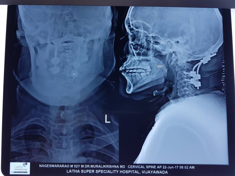 Best urology hospitals in Vijayawada,best urology doctors in Vijayawada,Best urology specialists in Vijayawada,best urology treatment hospitals in Vijayawada,Best paediatric urologists in Vijayawada,Best kidney Stone treatment in Vijayawada,Best prostate Gland treatment in Vijayawada,Best Laparoscopic Surgery in Vijayawada,Best Bladder Stone treatment in Vijayawada,Best Ureters Treatment in Vijayawada,Best Retrograde ureteral in Vijayawada,Best kidney transplantation in Vijayawada,Best prostatic hyperplasia Treatment in Vijayawada,Best Urologist in Vijayawada,Best Urinary Incontinence Treatment in Vijayawada,Best Gastroenterologists in Vijayawada,Best Gastroenterology hospitals in Vijayawada,Best Gastroenterology hospital in Vijayawada,Best gastroenterology treatment in Vijayawada,Best Gastroenteritis Treatment in Vijayawada,Best Hepatitis B Treatment in Vijayawada,Best Hernia Treatment in Vijayawada,Best Gallstones Treatment in Vijayawada,best neurosurgeon in Vijayawada,Best Brain tumor hospitals in Vijayawada,Best Stroke treatment in Vijayawada,Best Paralysis Treatment in Vijayawada,Best Rehabilitation Center in Vijayawada,Best Paediatric neurosurgery in Vijayawada,Best Neurovascular surgery in Vijayawada,Best Spine surgery in Vijayawada,Best Arthritis treatment in Vijayawada,Best Tumor removal in Vijayawada,Best Brain tumor treatment in Vijayawada,Best Neuro Surgery hospital in Vijayawada,Best neurology hospitals in Vijayawada,Best neurology doctors in Vijayawada,Best Neurologists in Vijayawada,best neurologist doctor in Vijayawada,Best Fits treatment in Vijayawada,Best Stroke Center in Vijayawada,Best Paralysis treatment in Vijayawada,Best Coma treatment center in Vijayawada,Best Migraine Hospital in Vijayawada,Best Spinal Card Injury Treatment in Vijayawada,best laparoscopic surgeon in Vijayawada,Best gall bladder stone removal surgery cost in Vijayawada,best general surgeon in Vijayawada,best gallbladder laparoscopic surgeon in Vijayawada,Best Advanced Laparoscopic and General Surgery in Vijayawada,Best Laparoscopic General Surgery in Vijayawada,best surgeon in Vijayawada,Top Laparoscopic surgeon Vijayawada,Best laparoscopic surgery hospitals in Vijayawada,Best Appendix Treatment in Vijayawada,Best Laparoscopic surgery in Vijayawada,Best Gallbladder microscope surgeons in Vijayawada,Advanced laparoscopic and general surgery hospitals in Vijayawada,Best General Surgery Hospitals in Vijayawada,best General Medicine Doctors in Vijayawada,Best General Physician Doctors in Vijayawada,Best General physicians in Vijayawada,Best General Medicine for Hypertension,Best Diabetologist in Vijayawada,Best Diabetics Hospital in Vijayawada,Best fever Hospital in Vijayawada,Best infections treatment in Vijayawada,Best Hypertension treatment in Vijayawada,Best thyroid treatment in Vijayawada,Best Hospitals for Pulmonology in Vijayawada,Best Pulmonologists in Vijayawada,Top Pulmonologists Doctors in Vijayawada,Best Pulmonology hospitals in Vijayawada,Best Asthma treatment in Vijayawada,Best Lung cancer treatment in Vijayawada,Best breathe easy treatment in Vijayawada,Best Asthma Specialist in Vijayawada,Best gynaecology hospitals in Vijayawada,Best gynaecology specialists in Vijayawada,best gynaecology hospitals in Vijayawada,Best obstetrics and gynaecology hospitals in Vijayawada,Best obstetrics and gynaecology doctors in Vijayawada,Best Uterine Bleeding treatments in Vijayawada,Best Painless Delivery Hospital in Vijayawada,Best High risk Pregnancy hospital in Vijayawada,best Orthopaedician in Vijayawada,best orthopaedic doctor in Vijayawada,Total Knee Replacement in Vijayawada,Best Knee Replacement surgery in Vijayawada,best Knee Replacement surgeon in Vijayawada,Hip Replacement in Vijayawada,Best joint replacement in Vijayawada,best Hip Replacement surgeon in Vijayawada,Best Fracture treatment in Vijayawada,Best injury treatments in Vijayawada,Best Arthritis treatment in Vijayawada,Best paediatrics specialists in Guntur,Best paediatrics physicians in Guntur,Best children’s paediatrics in Guntur,Best paediatrics and child health care hospitals in Guntur,Best general paediatrician in Guntur,best children’s hospitals in Guntur,Best Chest Specialists in Vijayawada,Best Chest physicians in Vijayawada,Best Chest Physician Hospitals in Vijayawada,Best pulmonologist doctors in Vijayawada,best lungs specialist in Vijayawada,Best lungs hospital in Vijayawada,Best asthma specialist in Vijayawada,Best ENT clinics in Vijayawada,best ent specialists in Vijayawada,best ENT doctors in Vijayawada,best ENT hospitals in Vijayawada,MICRO EAR SURGERIES in Vijayawada,Best SINUSITIS Treatments in Vijayawada,Best TONSILLITIS Treatments in Vijayawada,Best Hearing Loss Treatment in Vijayawada,Best Sore Throat Treatment in Vijayawada,Best Anaesthesiology Doctors in Vijayawada,Best Anaesthesiology Services for Surgery in Vijayawada,Best Anaesthesiology Critical Care in Vijayawada,Best Pain Management Doctors in Vijayawada,Best intensive care specialist in Vijayawada,best Accident & Emergency Hospitals in Vijayawada,Best Emergency Services Providers in Vijayawada,Best Emergency care in Vijayawada,Best Accident Injuries Treatment in Vijayawada,Best Skin Specialists in Vijayawada,Best Skin Care Clinics in Vijayawada,Best Dermatologist Doctors in Vijayawada,Best Radiologists in Vijayawada,Best Radiology Clinics in Vijayawada,Best radiology doctors in Vijayawada,Best female radiologist in Vijayawada,Best Dental Hospitals in Vijayawada,Best Dental Doctors in Vijayawada,Best Clip Treatment in Vijayawada,Best Orthodontist in Vijayawada,Best braces treatment in Vijayawada,Best Root Canal Treatment in Vijayawada,Best Dental Implant Center in Vijayawada,Best Dentist in Vijayawada,Best Gum diseases treatment in Vijayawada